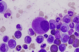 Desarrollan en la UNAM nanofármaco contra la leucemia linfocítica aguda