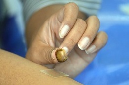 Diseñan microagujas poliméricas biodegradables por la piel para tratamiento de dislipidemias