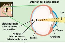 La miopía está en aumento, es necesario que menores reciban atenciones visuales regulares; 3 de cada 10 estudiantes de bachillerato la presentan  