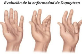 La contractura de Dupuytren, una afectación que se presenta más en hombres mayores de los 40 años, aunque en mujeres es más agresiva