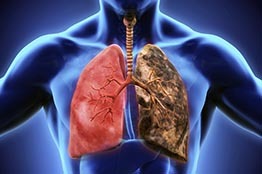 Cáncer de pulmón, el más evitable: Académico UNAM