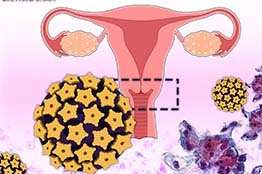 Papanicolaou y vacuna contra VPH, la mejor estrategia contra el cáncer cervicouterino